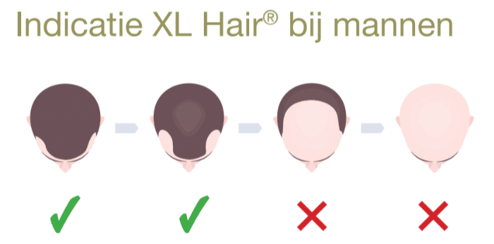 XL Hair mannen Amsterdam